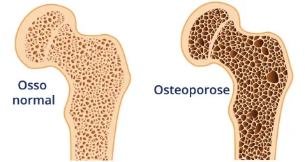 A osteoporose é uma doença silenciosa, mas com consequências profundas. Ela avança sem dor, sem aviso e, muitas vezes, só se revela após uma fratura.