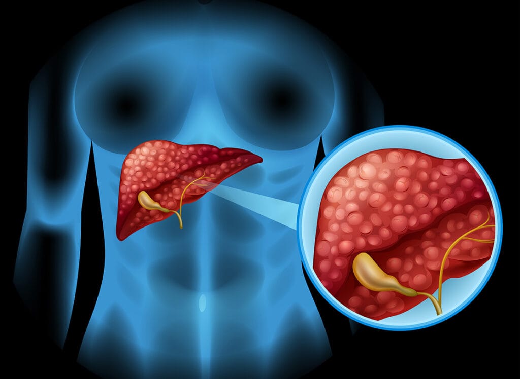 Saiba o que é gordura no fígado, sintomas, riscos e como prevenir essa doença silenciosa que cresce no Brasil.