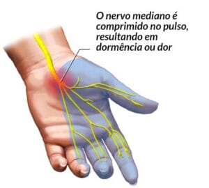 Saiba o que é a síndrome do túnel do carpo, quais são os sintomas, causas, diagnóstico e como prevenir esse problema cada vez mais comum.