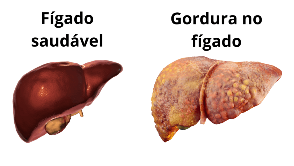 A gordura no fígado está cada vez mais associada a fatores metabólicos. Entenda causas, sintomas, riscos, diagnóstico, prevenção e tratamento.